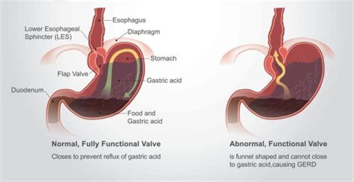 Can acid reflux affect the vocal cords?