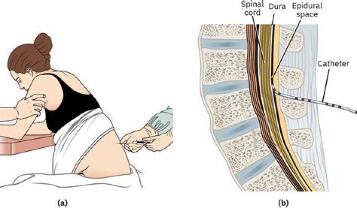 Can epidural wear off during the labor?