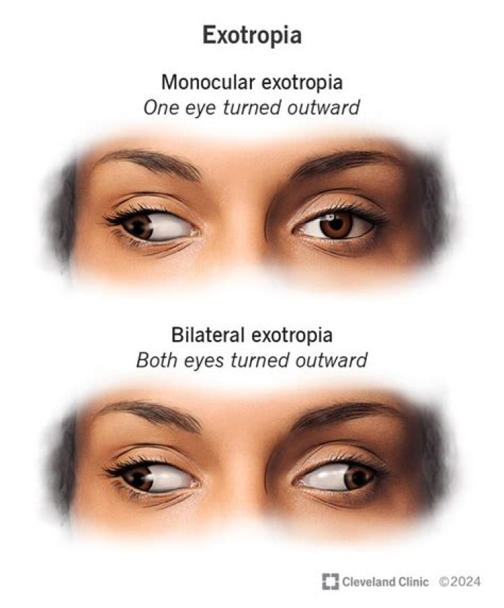 Can exophoria be corrected?