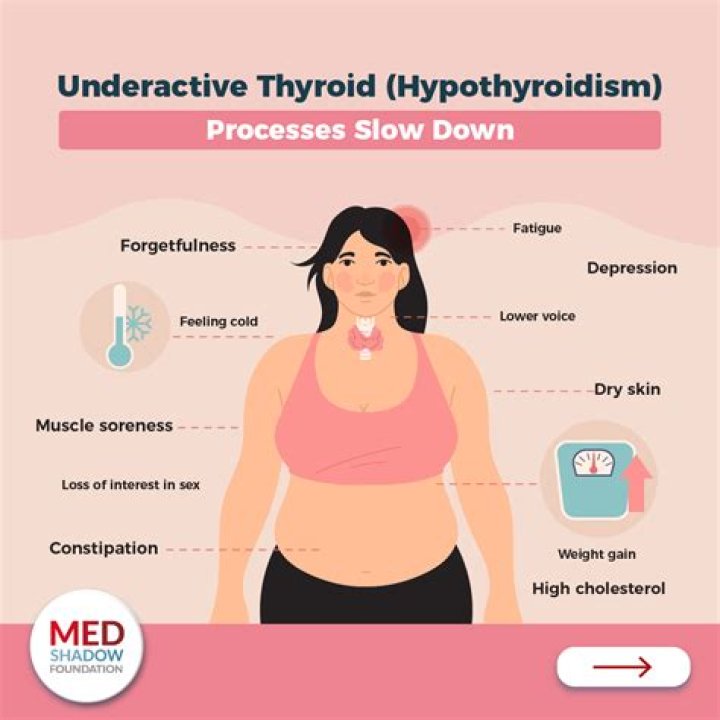 Can thyroid disease be mistaken for lupus?