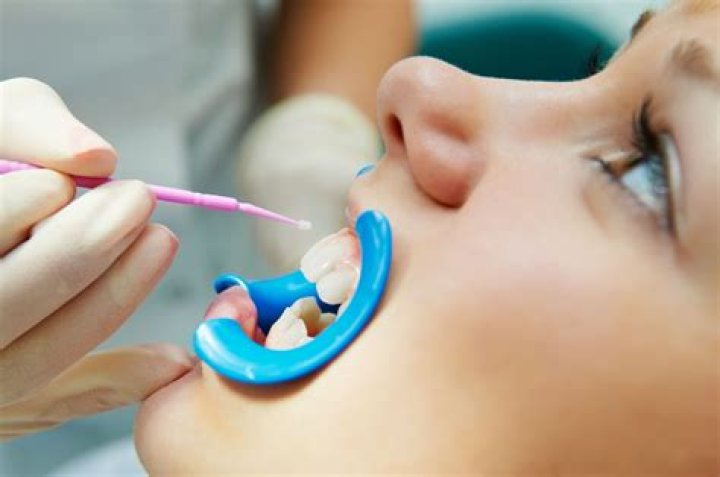 Can you apply fluoride after sealants?