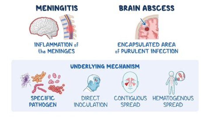 Can you get meningitis from an abortion?