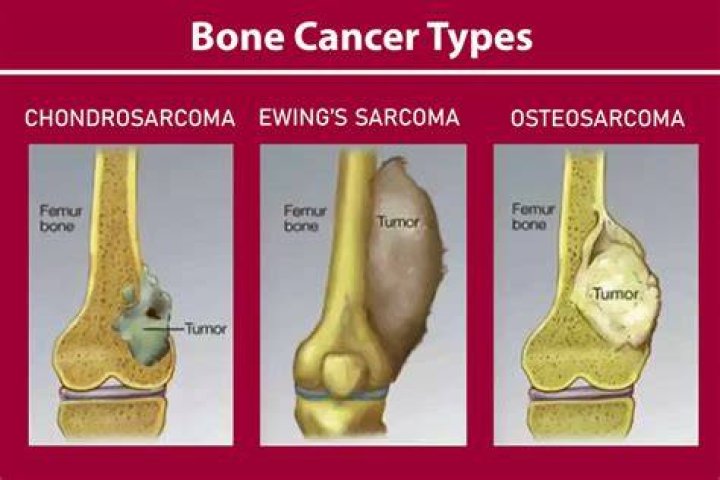 Can you survive metastatic osteosarcoma?