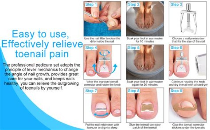 Do Pedicures remove ingrown toenails?