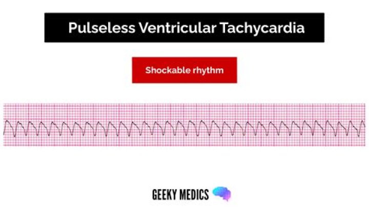 Do you shock pulseless v tach?