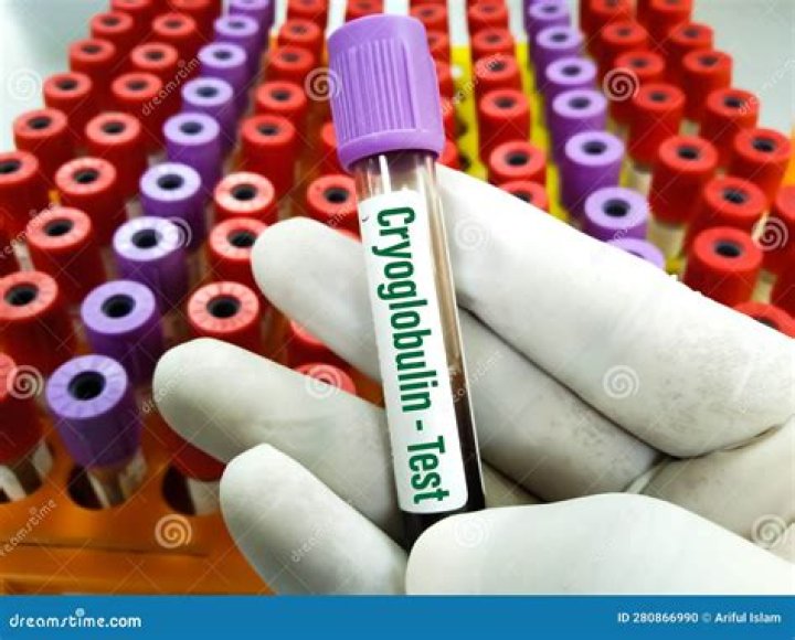 Does Cryoglobulin test require fasting?