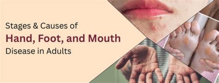 Does foot and mouth disease affect dogs?
