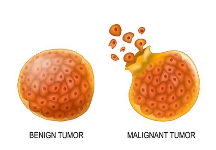 How are bone Tumours classified?