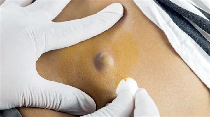 How are sinus cysts removed?