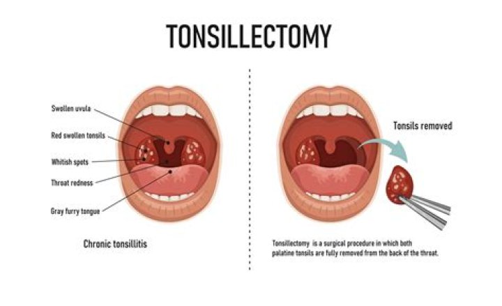 How can I reduce the swelling of my tonsils?