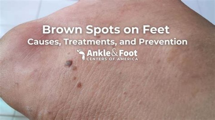 How do I fix brown spots on my skin?