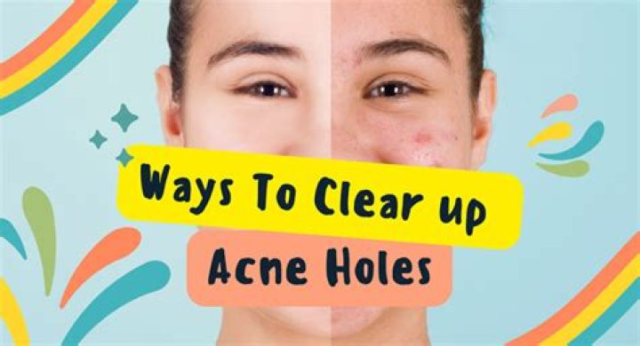 How do you fix acne holes in your skin?