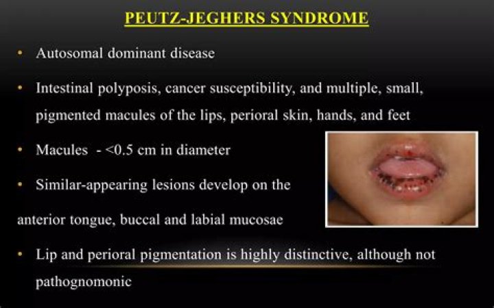 How is Peutz-Jeghers Syndrome diagnosed?