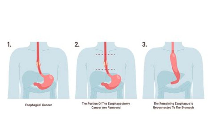 How long do you stay in the hospital after a thoracoscopy?
