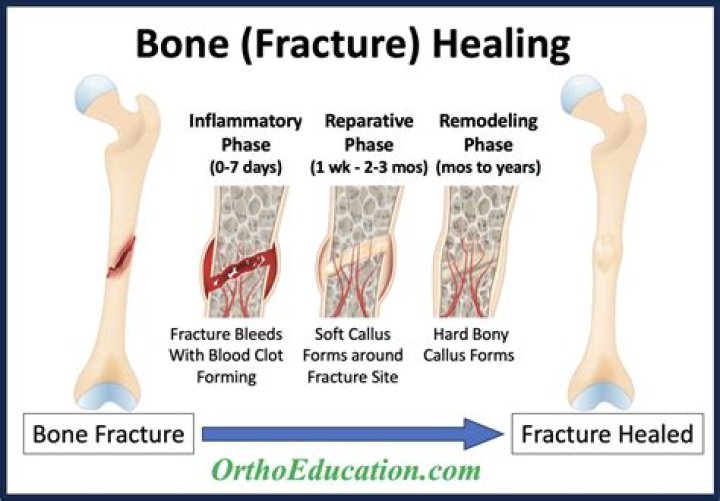 How long does a C1 fracture take to heal?
