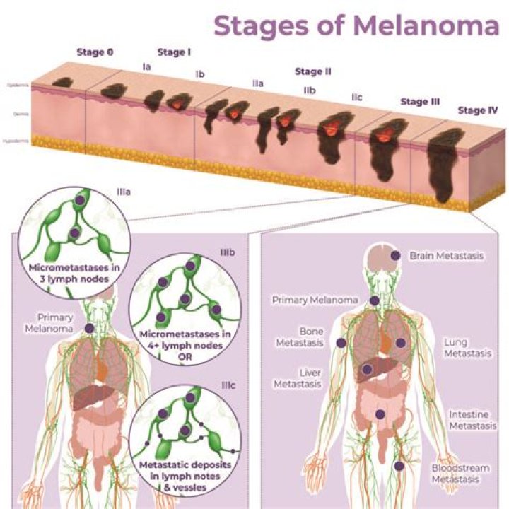 How many mm is melanoma?