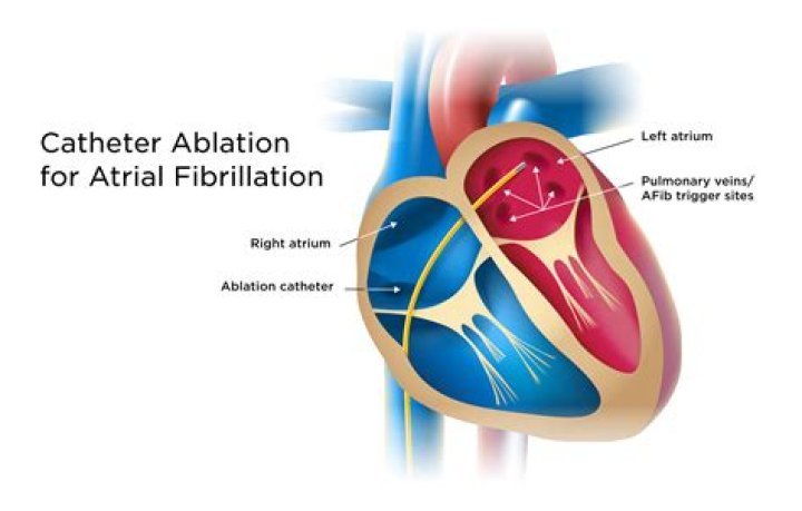 How successful is ablation for Afib 2021?