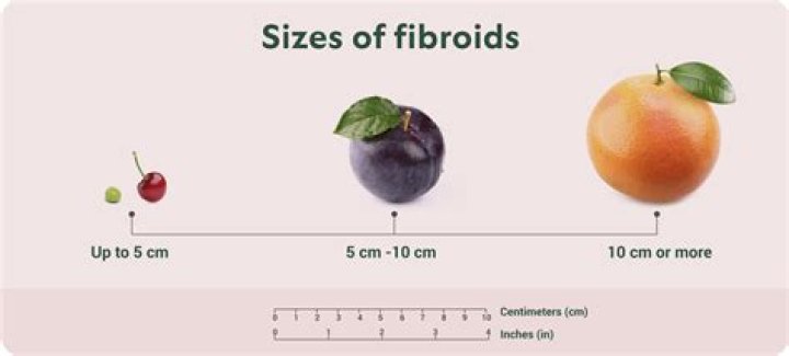 Is 6 cm fibroid large?