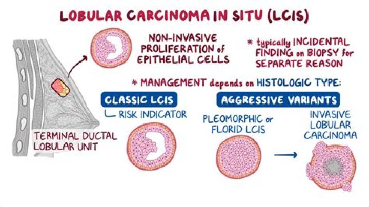 Is Chemo Effective for invasive lobular carcinoma?