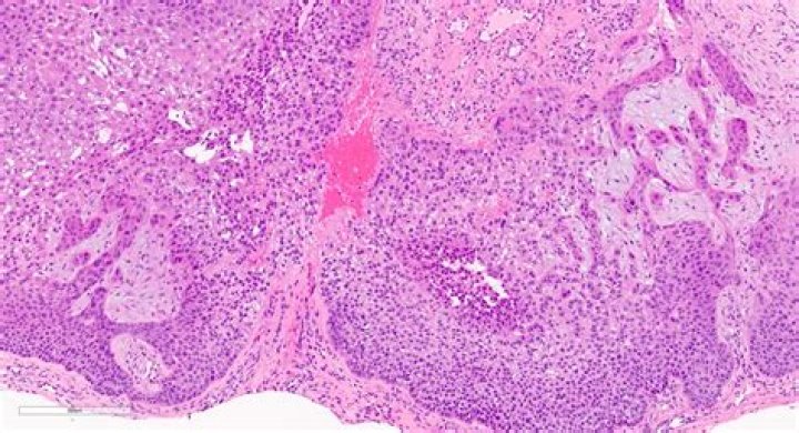 Is desmoplastic trichilemmoma benign?
