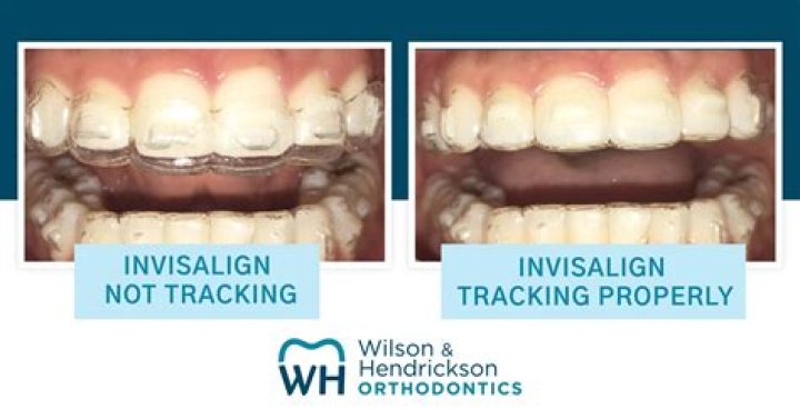Is it normal for your Invisalign to be loose?