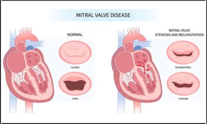 What can cause the appearance of mitral facies?