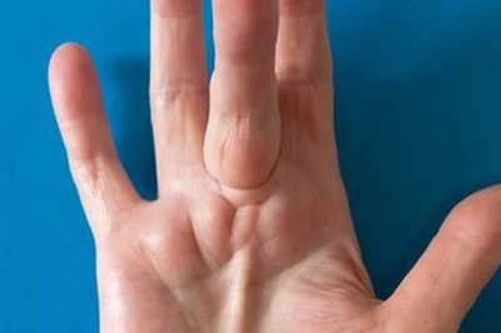 What causes lumps in the palm of my hand?