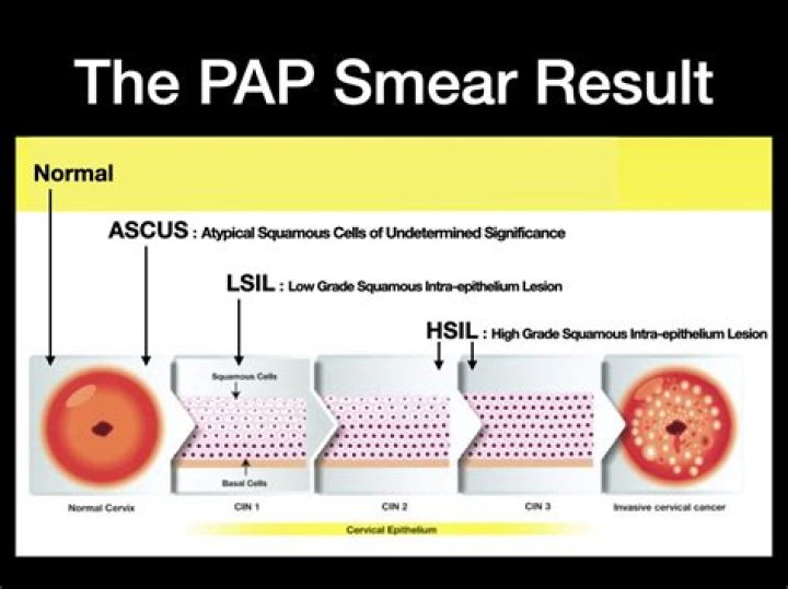 What does Ascus mean for a Pap smear?