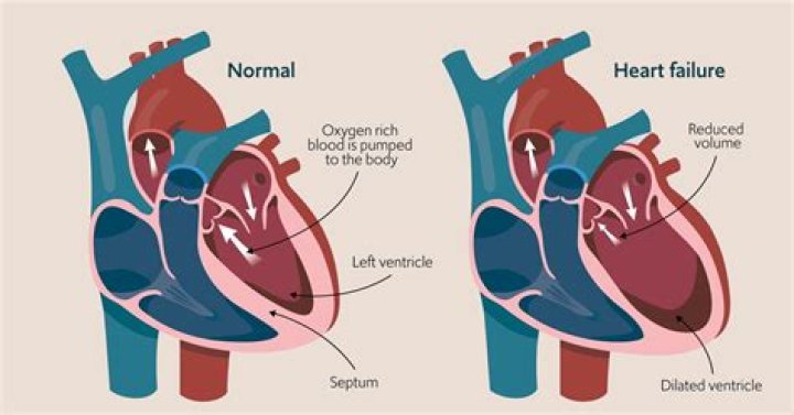 What heart failure looks like?