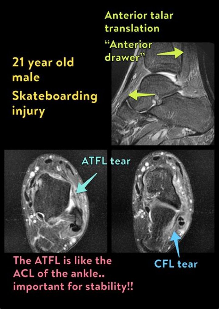 What is a CFL in ankle?