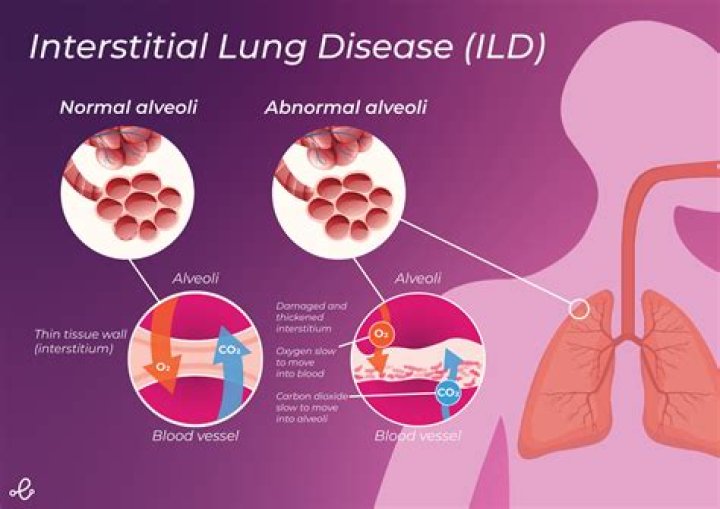 What is alveolar interstitial syndrome?