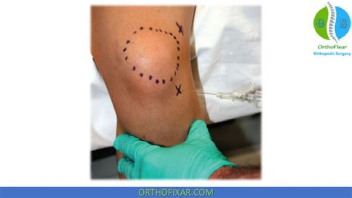 What is an advantage to a lateral approach to knee arthroplasty?