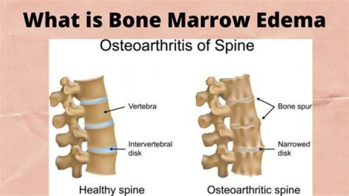 What is an edema in the spine?