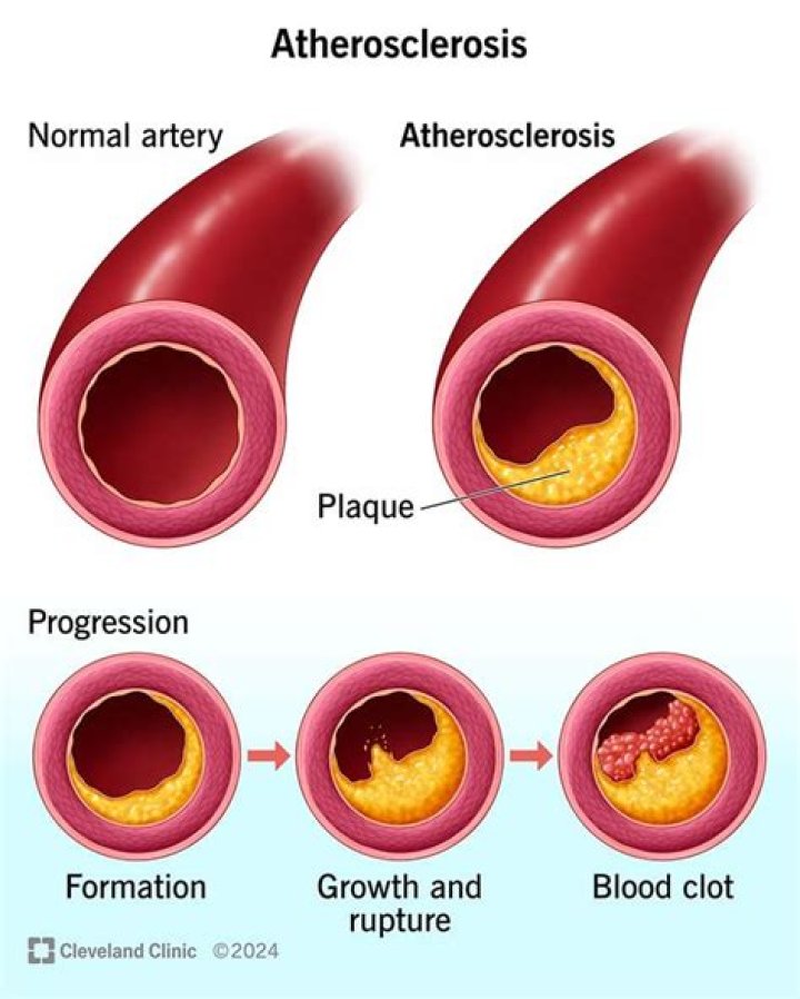 What is atherosclerosis explain?