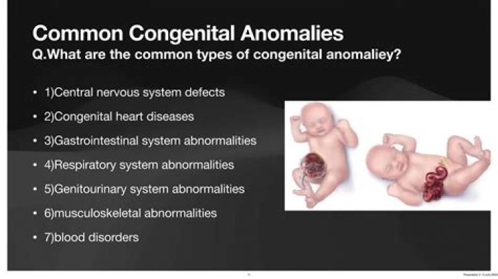 What is the most common congenital defect of congenital rubella syndrome?