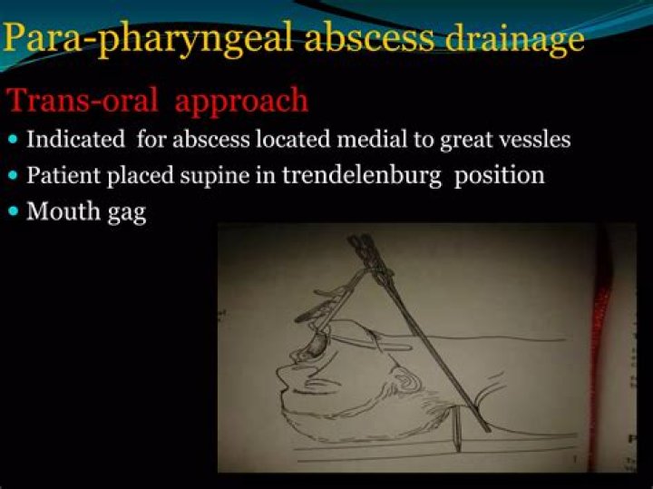 What is the transoral approach?