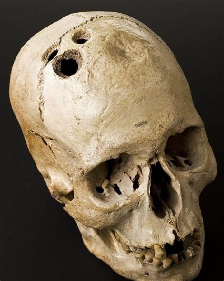 When did doctors drill holes in skulls?